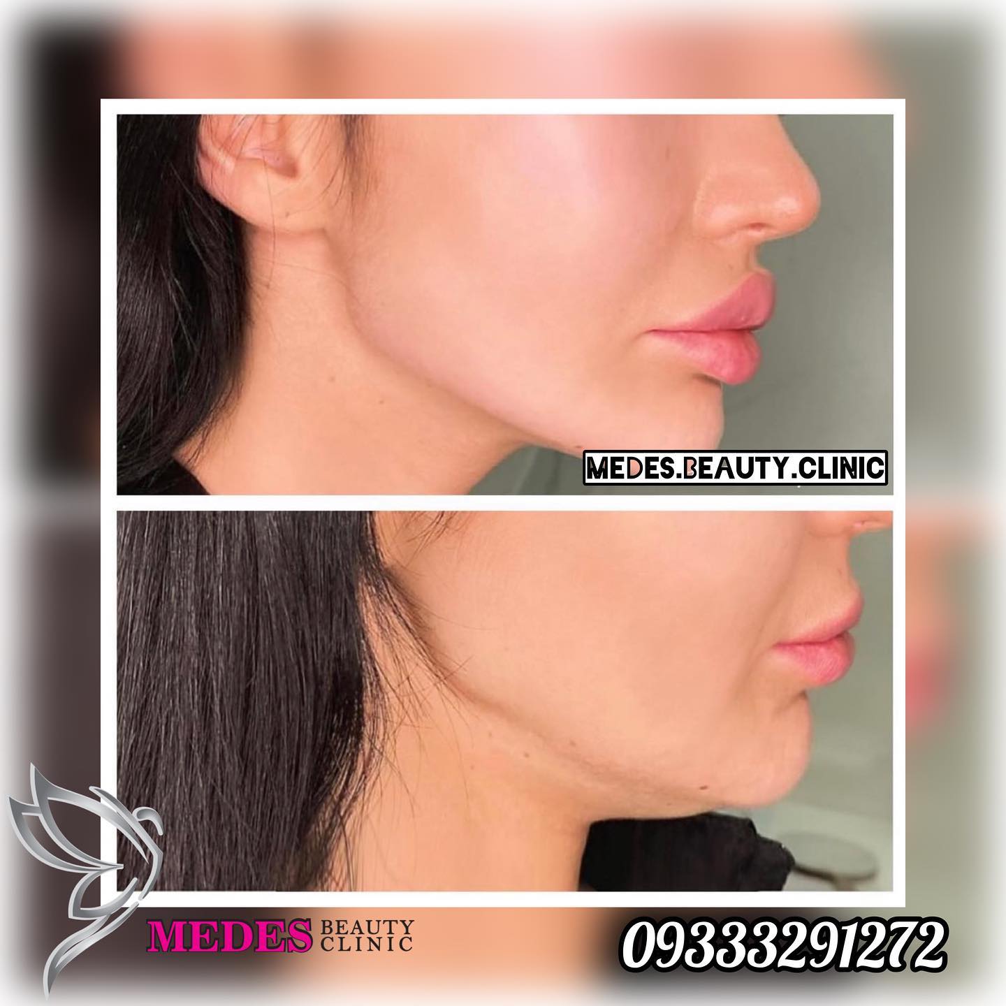 گالری زاویه سازی صورت